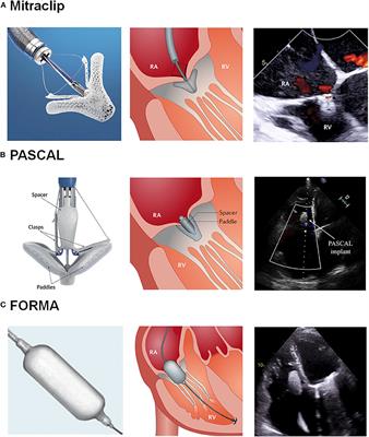 Transcatheter Tricuspid Valve Intervention: Coaptation Devices